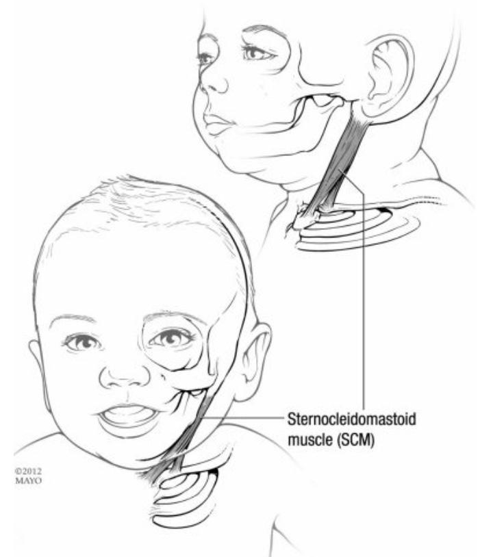 Torticollis Diagram